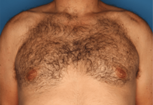 Laser hair removal patient before Splendor X treatment