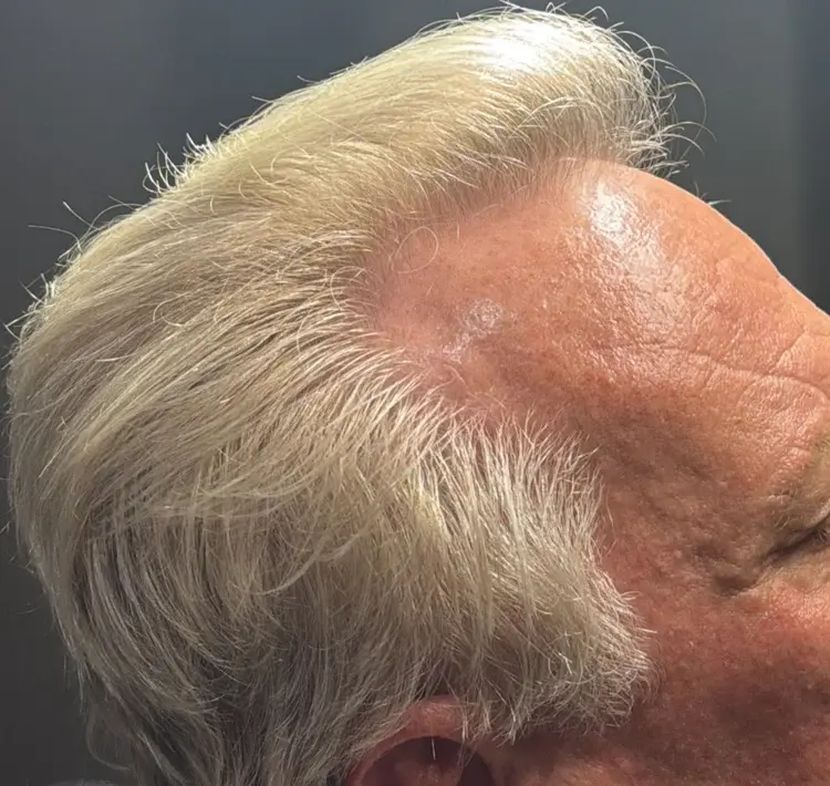 Hair restoration patient after Folix treatment showing regrowth