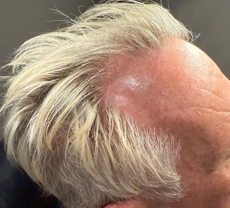 Hair restoration patient before Folix treatment