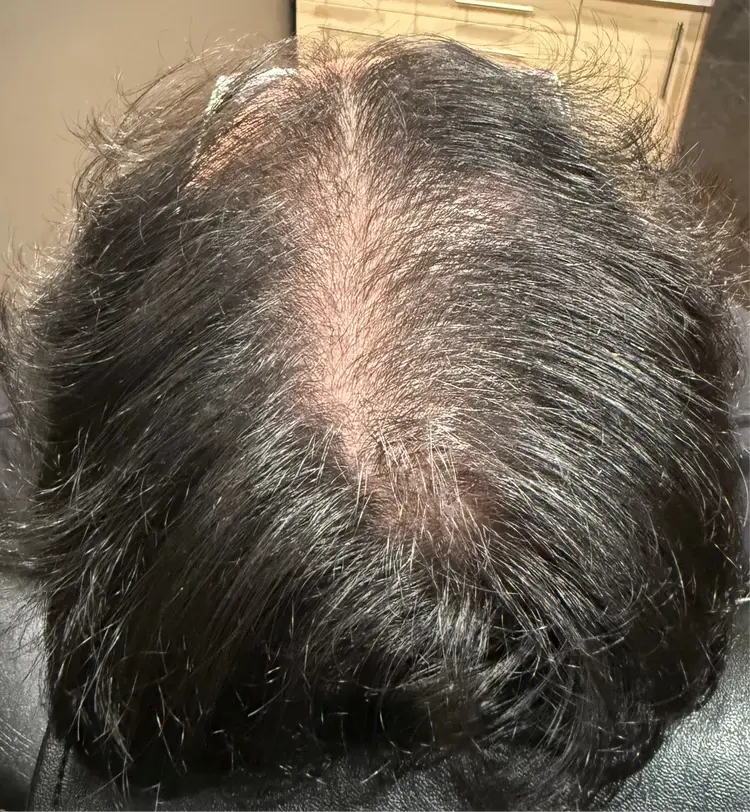 Hair restoration patient after Folix laser treatment showing visible improvement