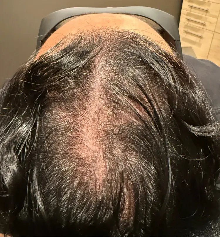 Hair restoration patient before Folix laser treatment