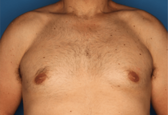 Laser hair removal patient after Splendor X treatment showing smooth results